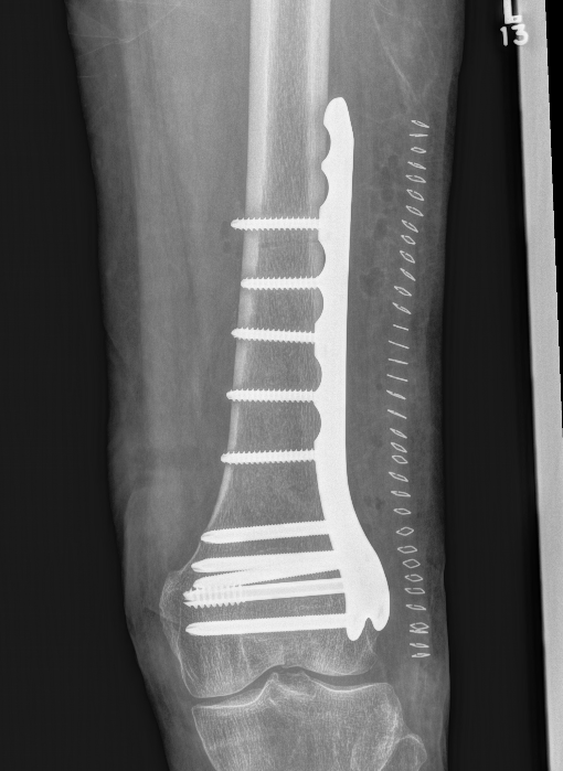 Distal femur plate